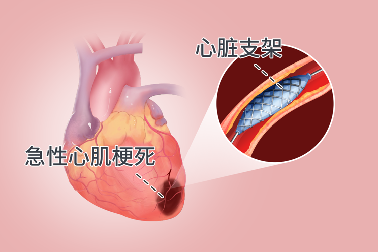 心脏支架手术：到底是治病救人还是“缺德害人”？告诉你真相